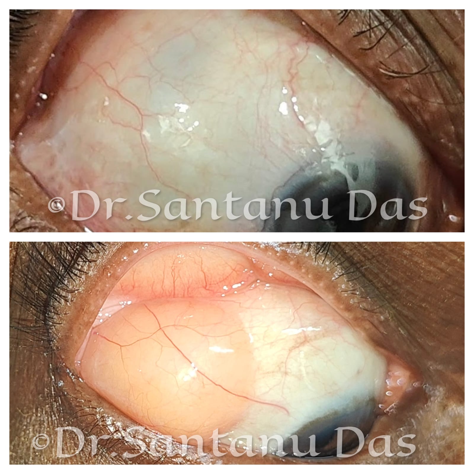 Ocular Surface Lesion